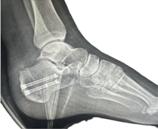 Achilles-Tendon-After-image-1