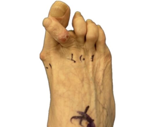 hammertoe-surgery-result-before