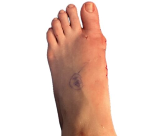 mis-bunion-surgery-after-image-1