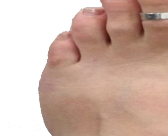 tailor-bunion-after-image-1