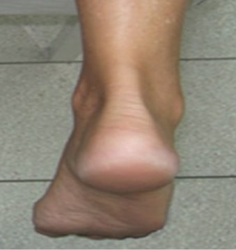 Normal Achilles tendon