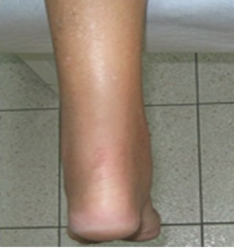 Achilles tendon rupture