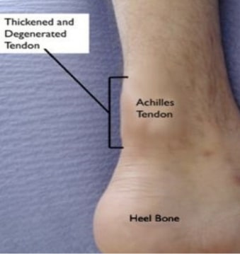 Achilles Tendinitis​