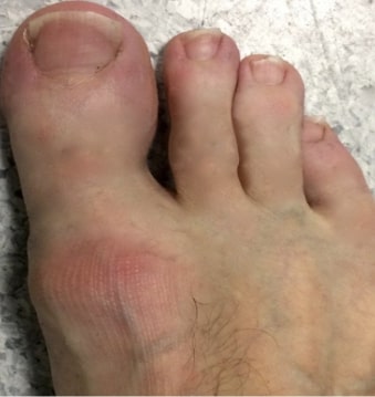 Arthritis big toe joint Image