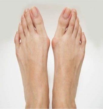 Bunions Image