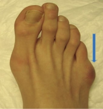 Tailor’s bunion​ Image