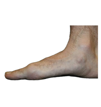 Mild Bunion