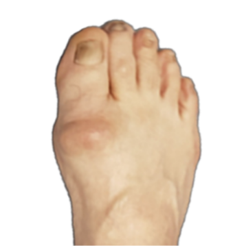 Arthritis big toe Image