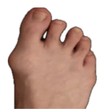 Bunions Image