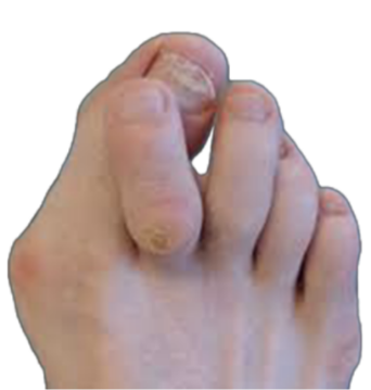 Hammer toe Image