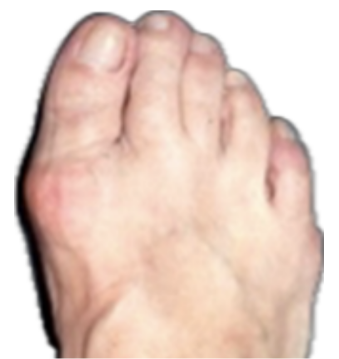 Mild Bunion