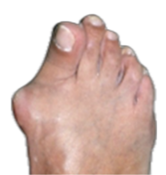 Severe Bunion​