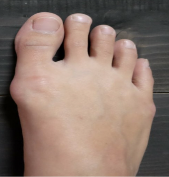 Mild Tailors bunion Image